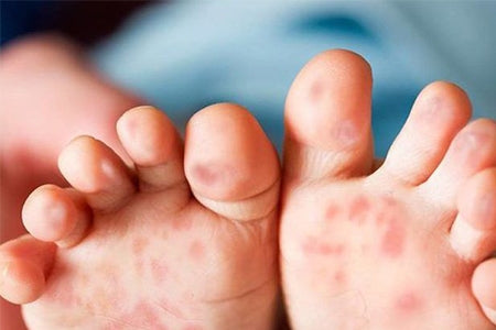 Tips For Hand Foot and Mouth Disease (HFMD)