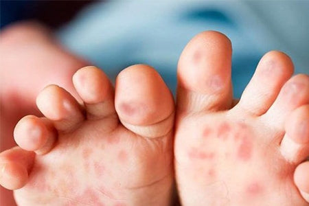 LITTLE TIPS ON HAND, FOOT, AND MOUTH DISEASE (HFMD)